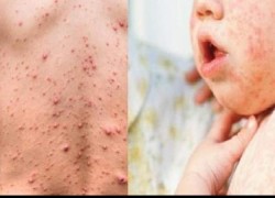 बाँकेमा दादुरको सङ्क्रमण तीव्र भइहहेका बेला सुर्खेतमा पनि पाँच जनामा सङ्क्रमण पुष्टि